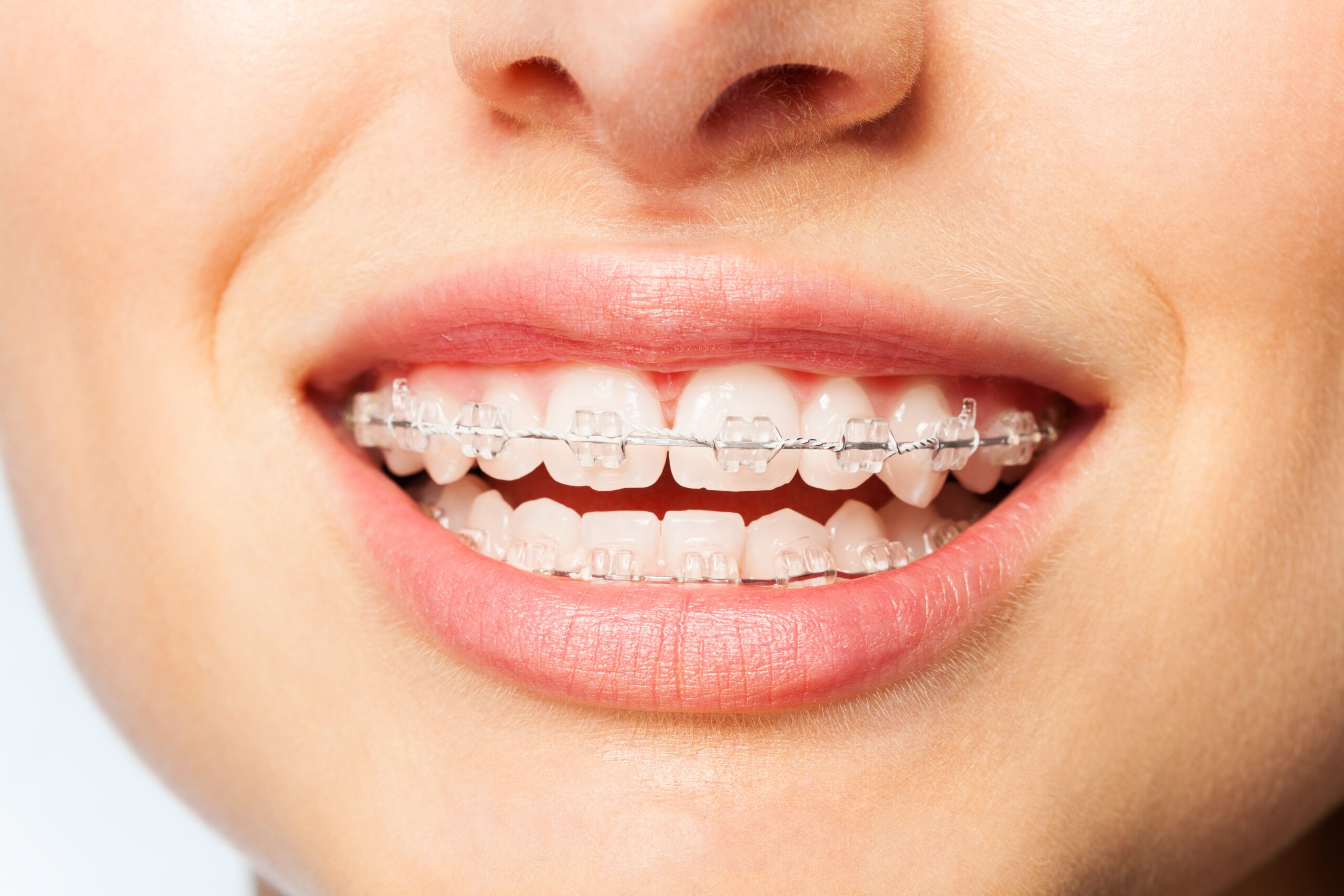 Your Guide to Clear Braces in Henderson and Las Vegas